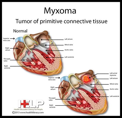 myxoma